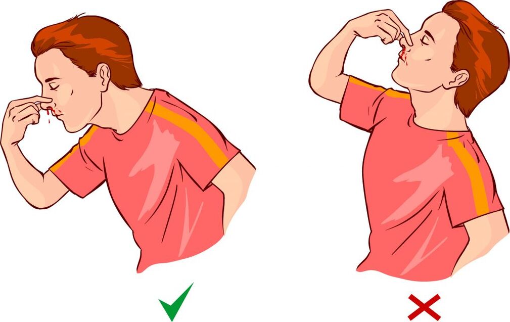 Epistaxis for hypertension
