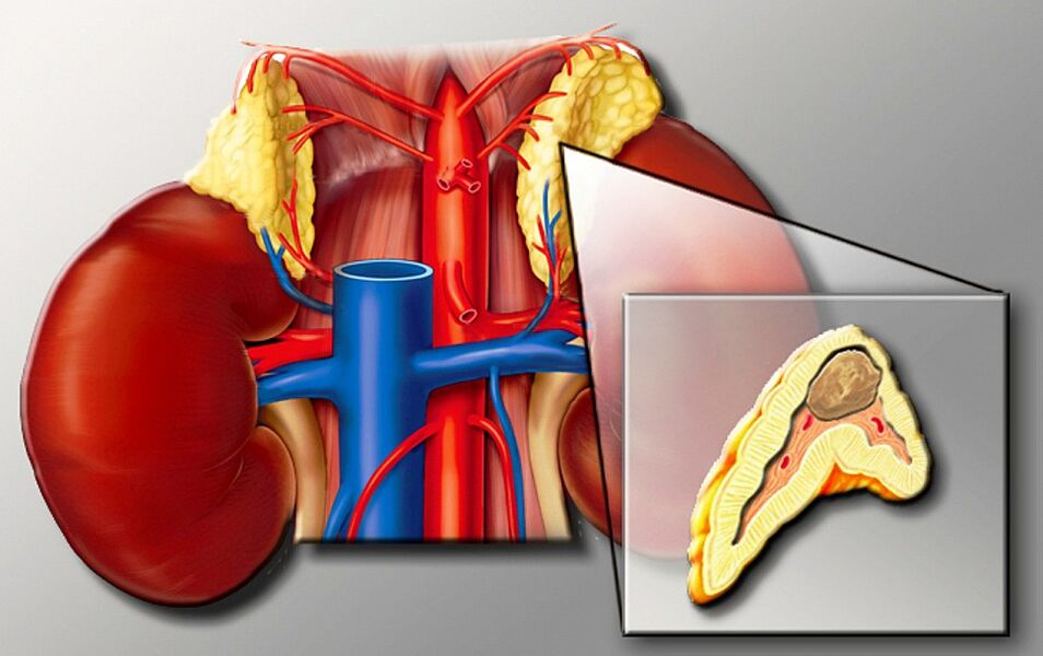 Feochromocytoma for hypertension