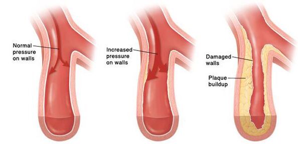 In hypertension, a violation of the patency of the vascular bed occurs